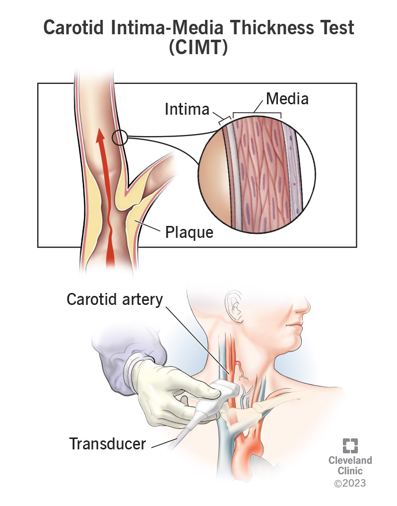 CIMT Test